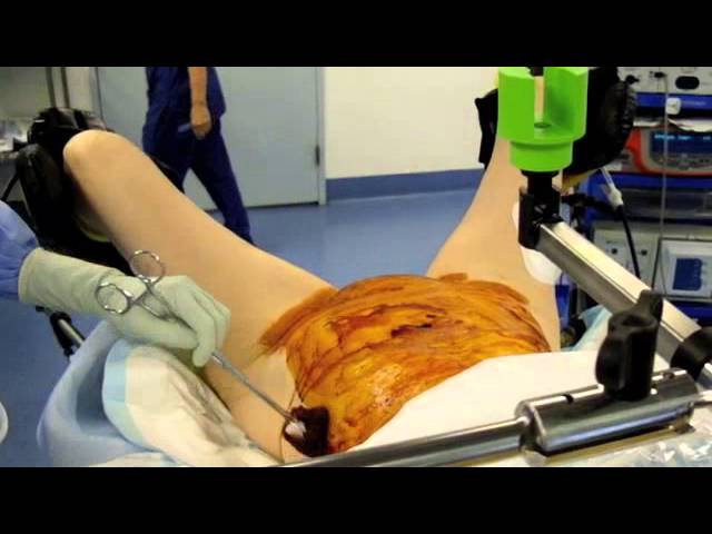 Laparoscopic Camera Holder by SurgiTools (7 years ago)