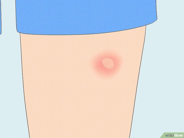 How to Identify Insect Bites